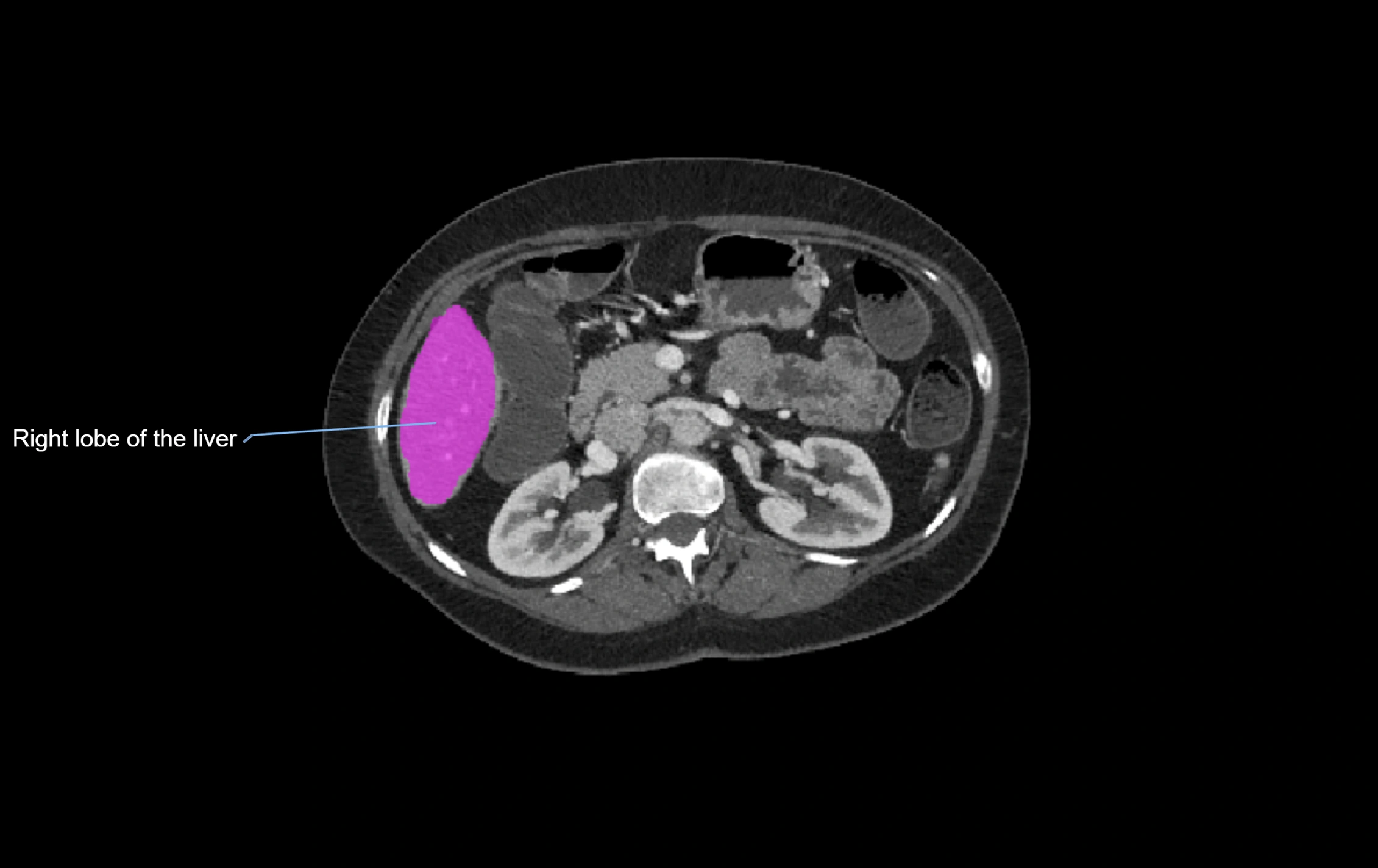 CT lliver lobes axial cross sectional anatomy labelled image -00025.webp